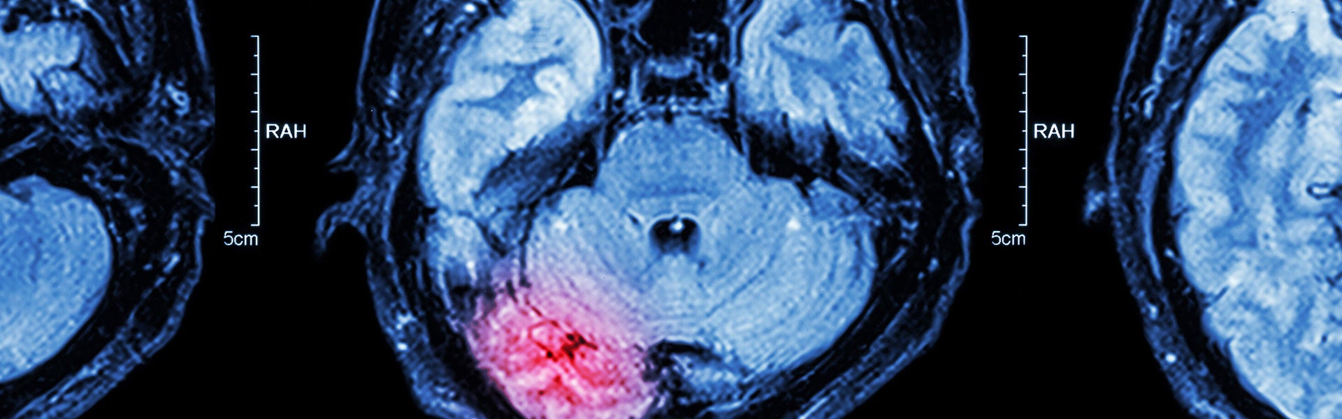 Traumatic Brain Injury